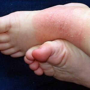 Dermatitis and Excema