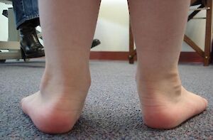 Flat Feet, Pronated Feet, Rolled in Feet
