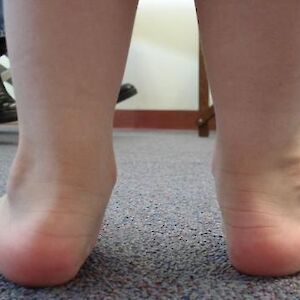 Flat Feet, Pronated Feet, Rolled in Feet
