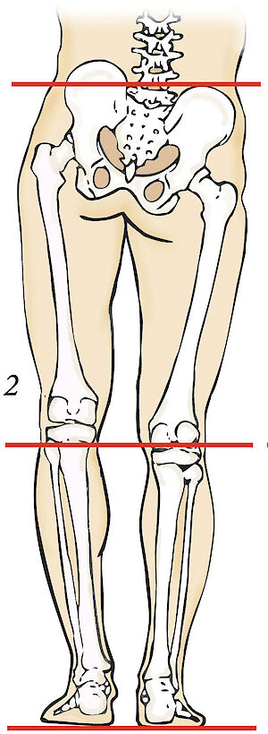 Functional Leg Length Difference
